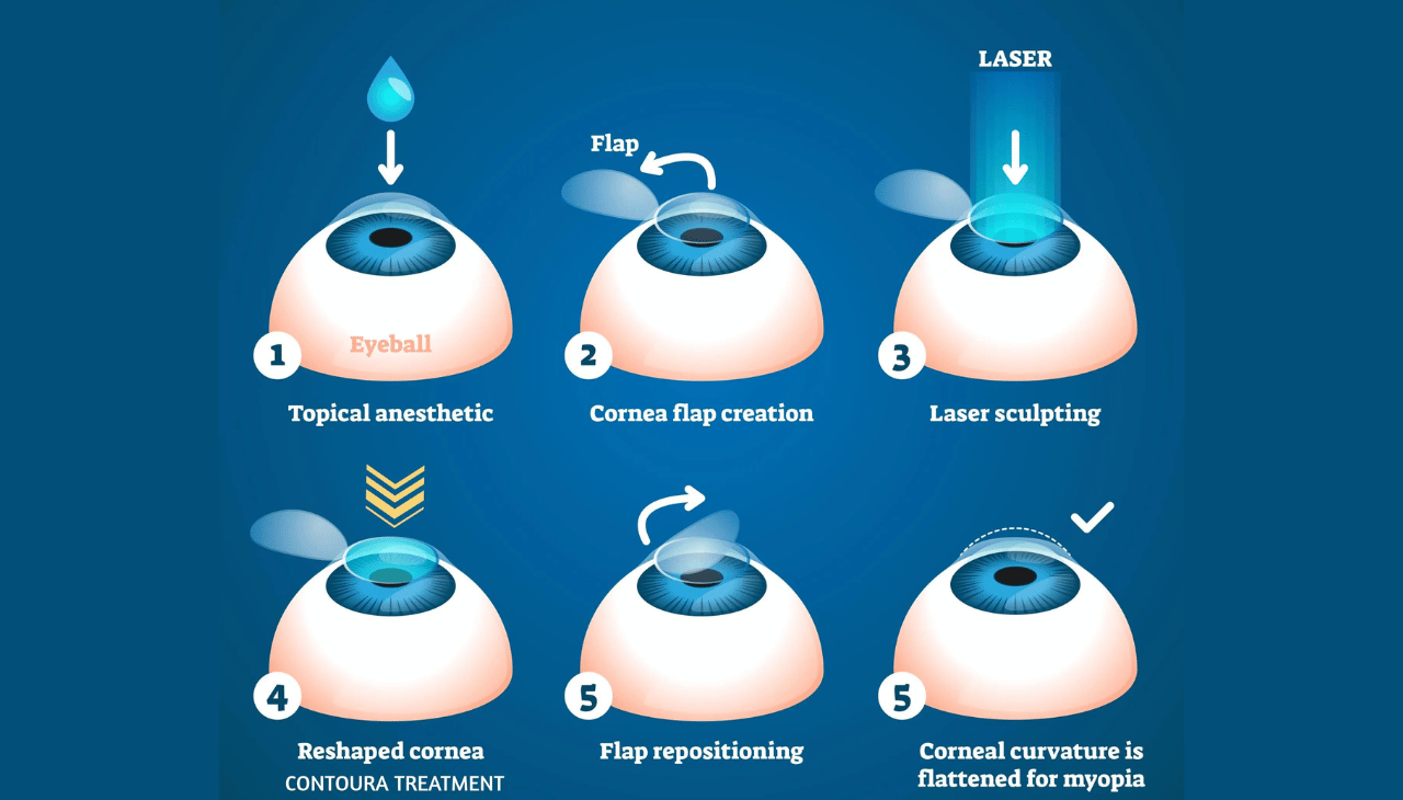 Contoura Vision LASIK vs Normal LASIK — Varanasi mein Kaunsa Behtar Hai?