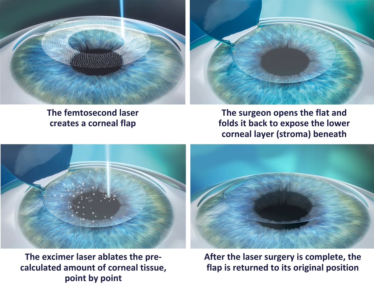 Contoura Vision LASIK vs Normal LASIK — Varanasi mein Kaunsa Behtar Hai?