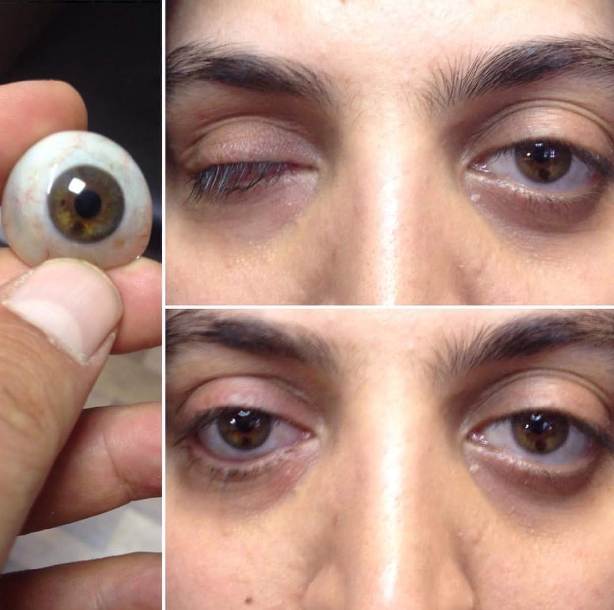 Oculoplasty
