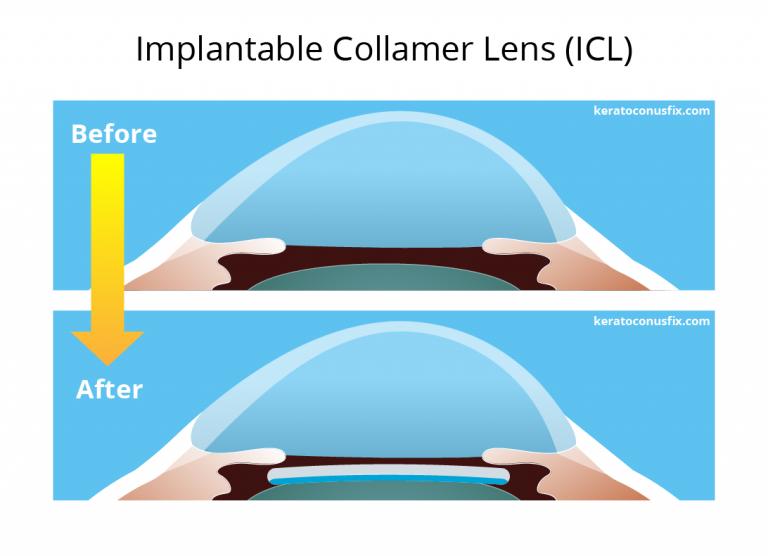 ICL-specs-removal