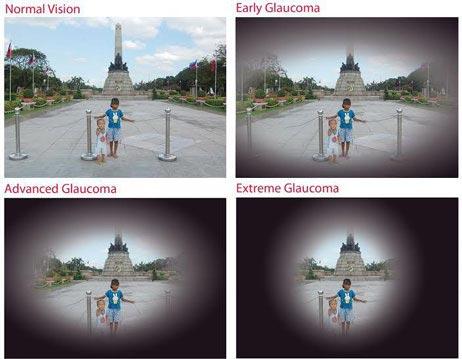 Glaucoma