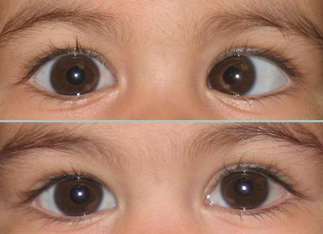 Squint surgery